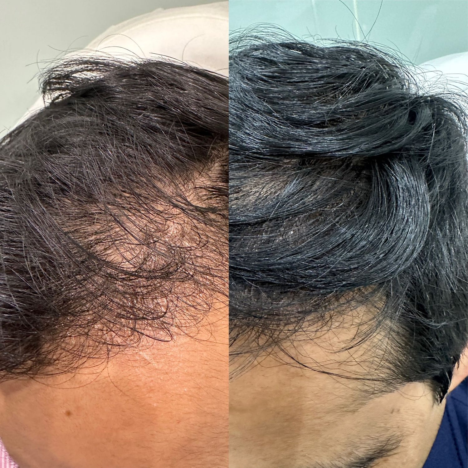 Entendiendo la Alopecia: Tipos y Tratamientos desde la Medicina Funcional